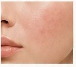 Red, stinging skin