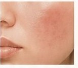 Sensitive, reddened skin